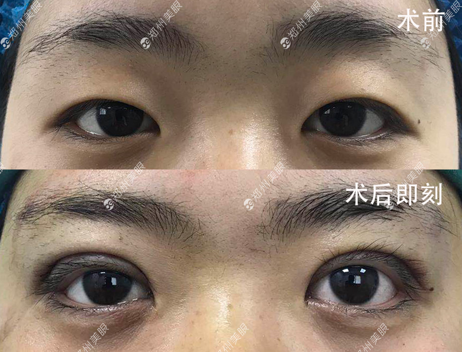 最新双眼皮手术技巧,创新割双眼皮方法解析